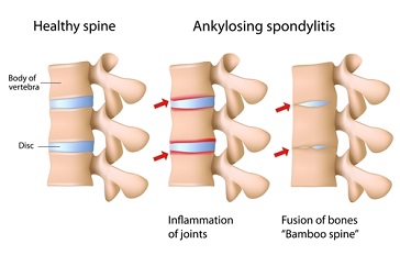A diagram showing the difference between an ankylosing spondylitis case and a healthy spine