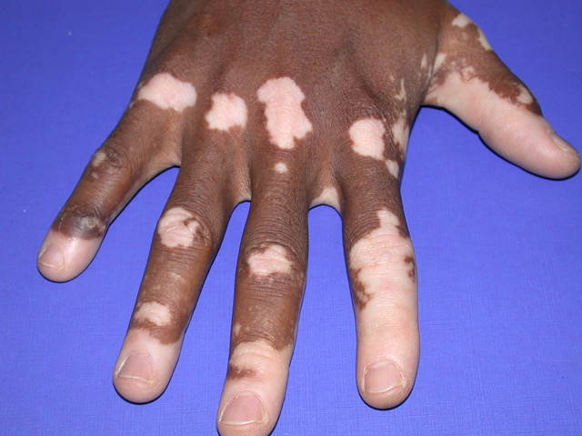 A hand typical of an autoimmune case